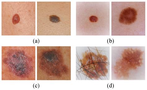pictures of early melanoma moles